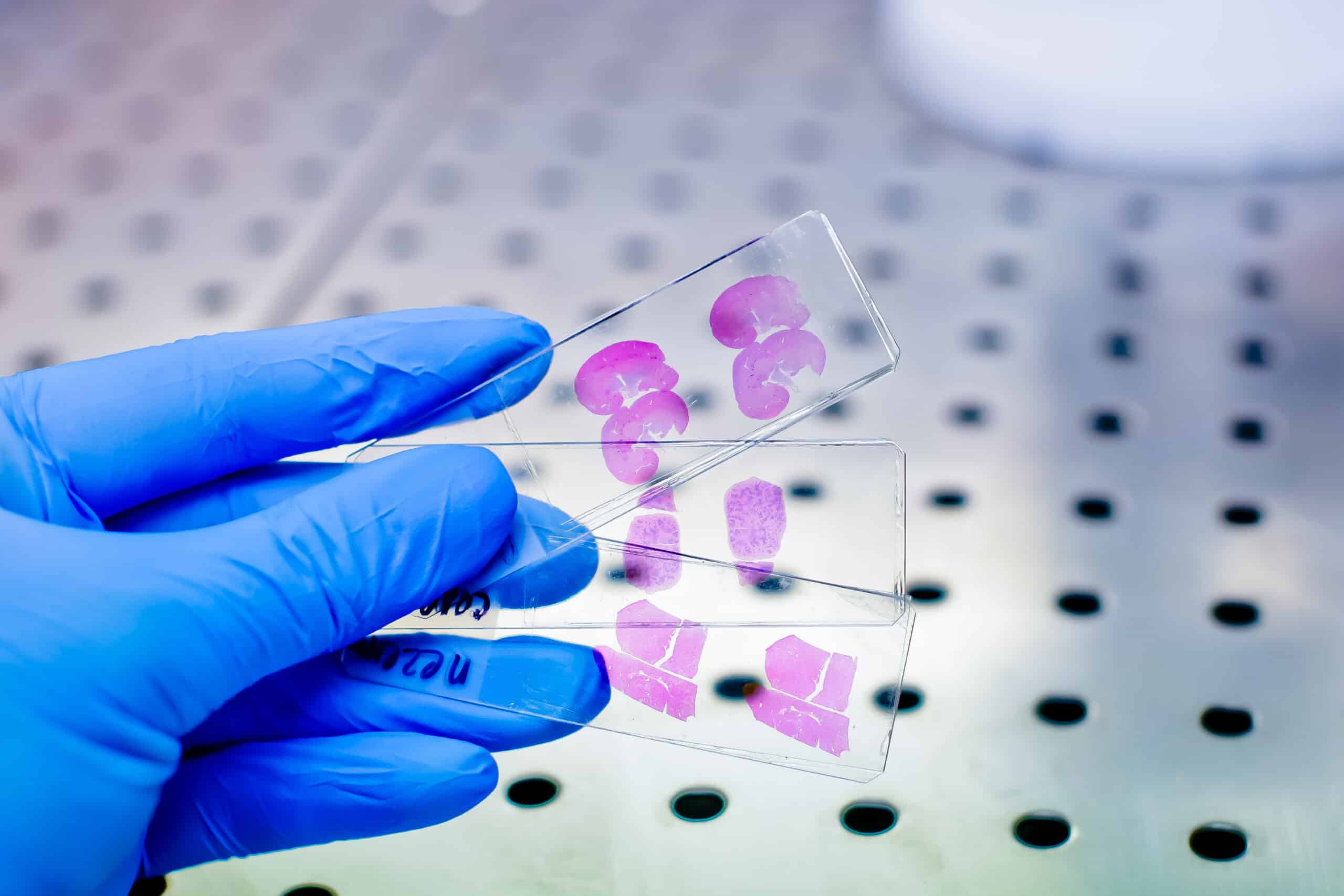 A gloved hand holding three glass slides with stained tissue samples on them