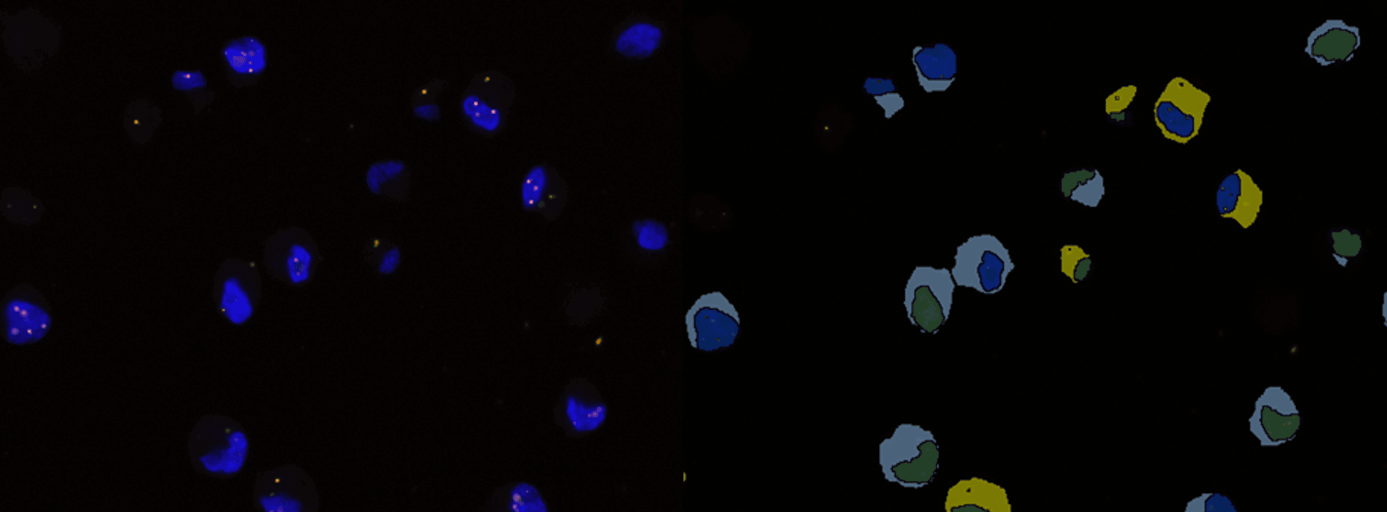 Interphase FISH with the EWSR1 break-apart probe